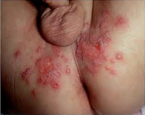 Genital herpes on the anus pics Arab fetish wiki
